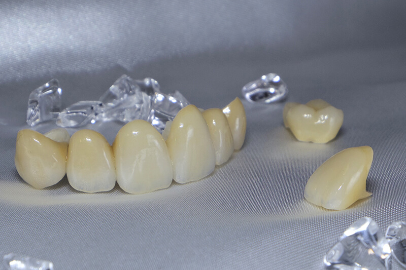 歯医者でできる審美治療の主な種類